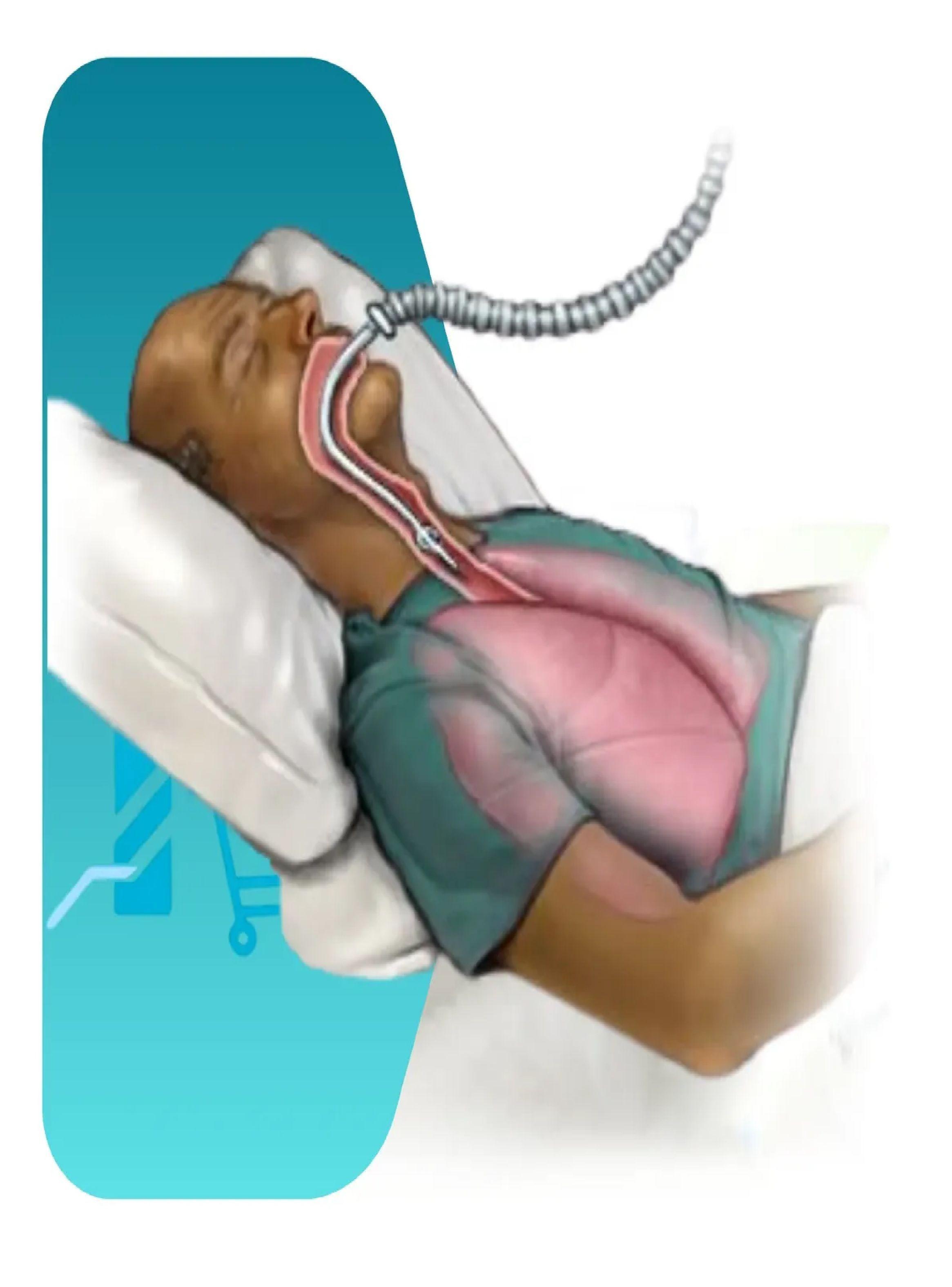 Tubo Endotraqueal Sin Balon Cranberry 5mm-2