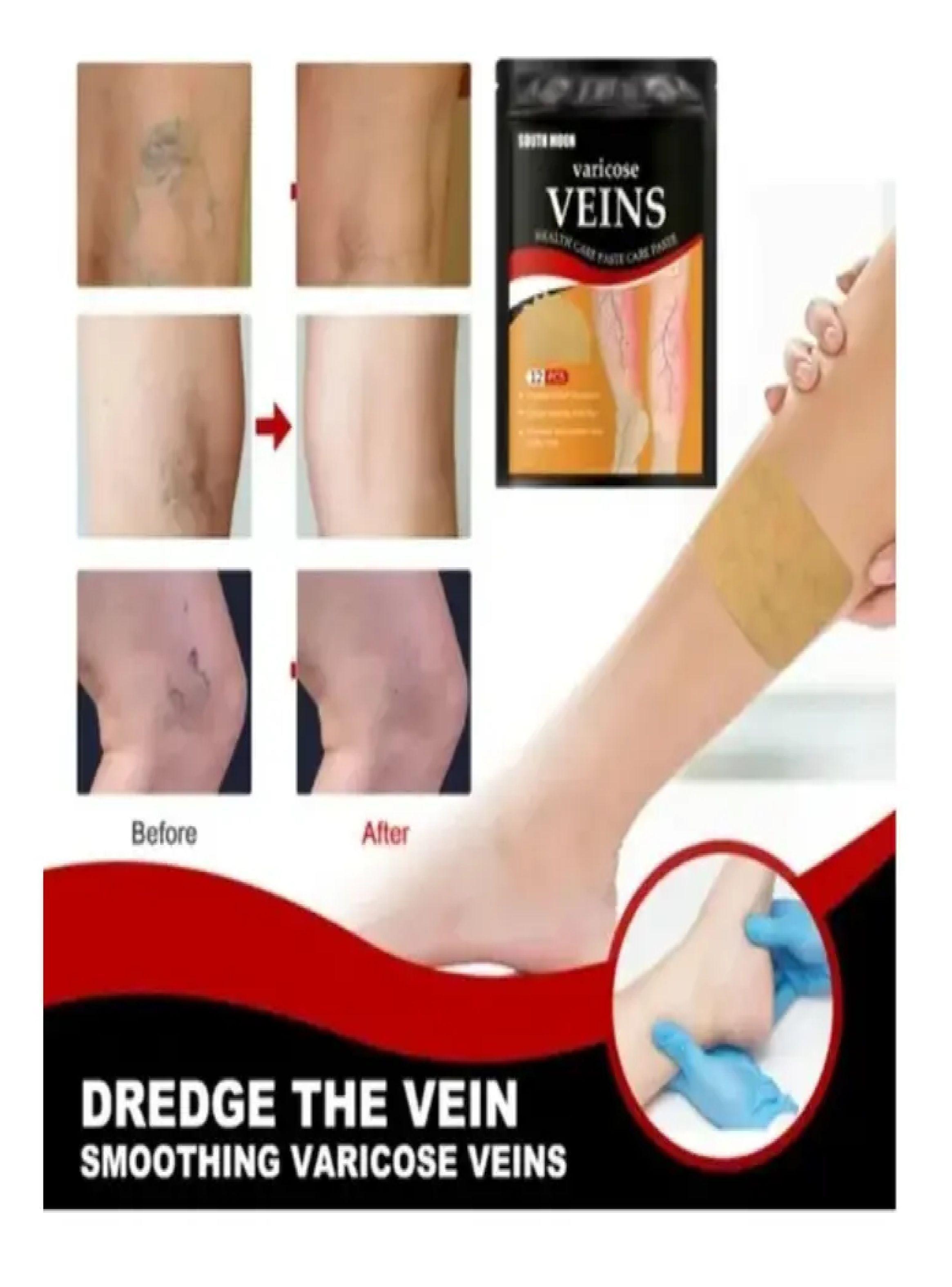 Medias Antiembolica Trombosis Venosa Parche Varices-4