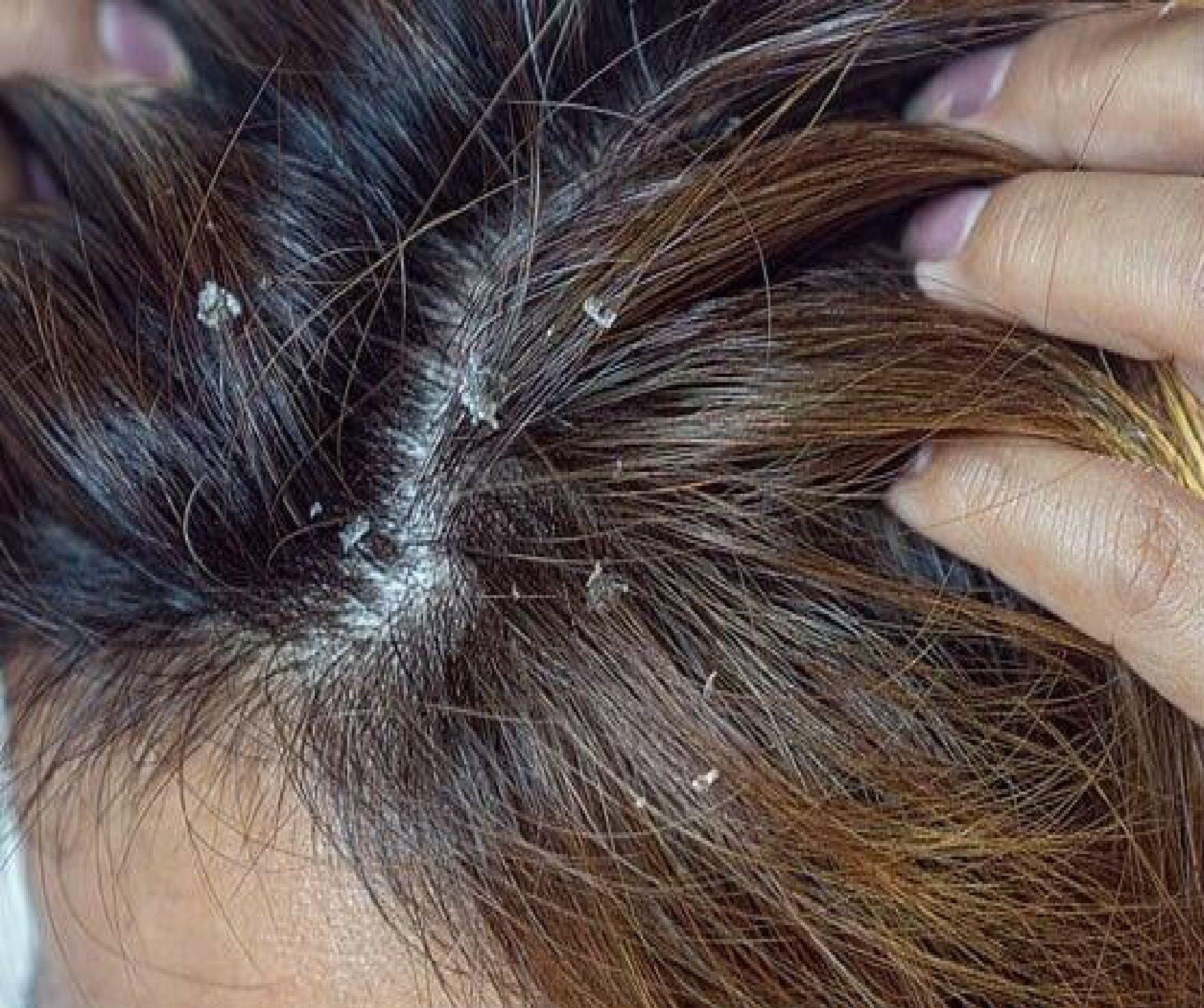 Shampoo anticaspa Biogel 1% Seborrea Dermatitis Purificador -2