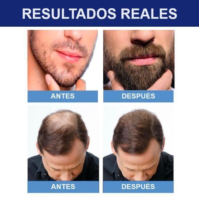 Minoxdil Kirkland 60ml Crecimiento Cabello Extrafuerte Usp5%-4