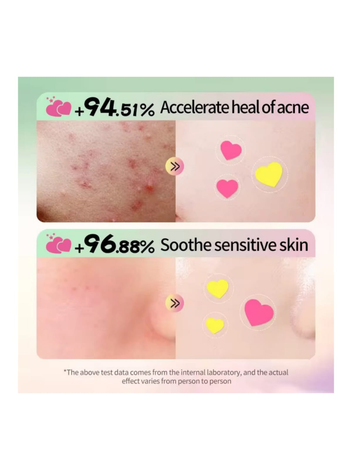 Parches para Acn Sadoer Hidrocoloide Corazones Set 144 Unidades Coloridos-2