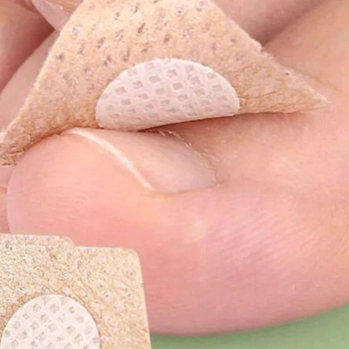 SET 5 PACK PARCHE PARA TRATAMIENTO UÑAS ANTIHONGOS LAU-2