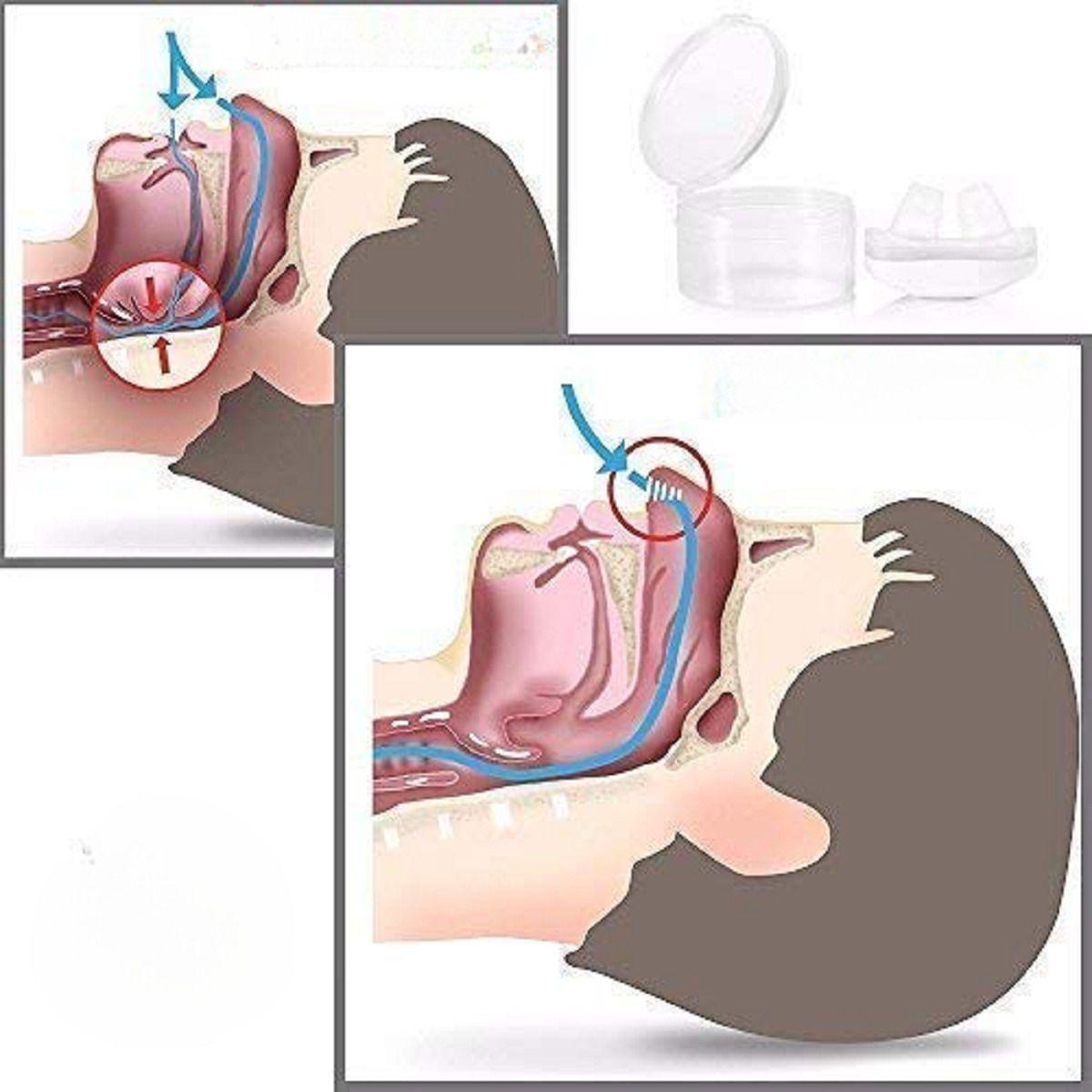 Set 6 Dispositivo Antirronquido 2 en 1 Nasal Purificador Lau-2