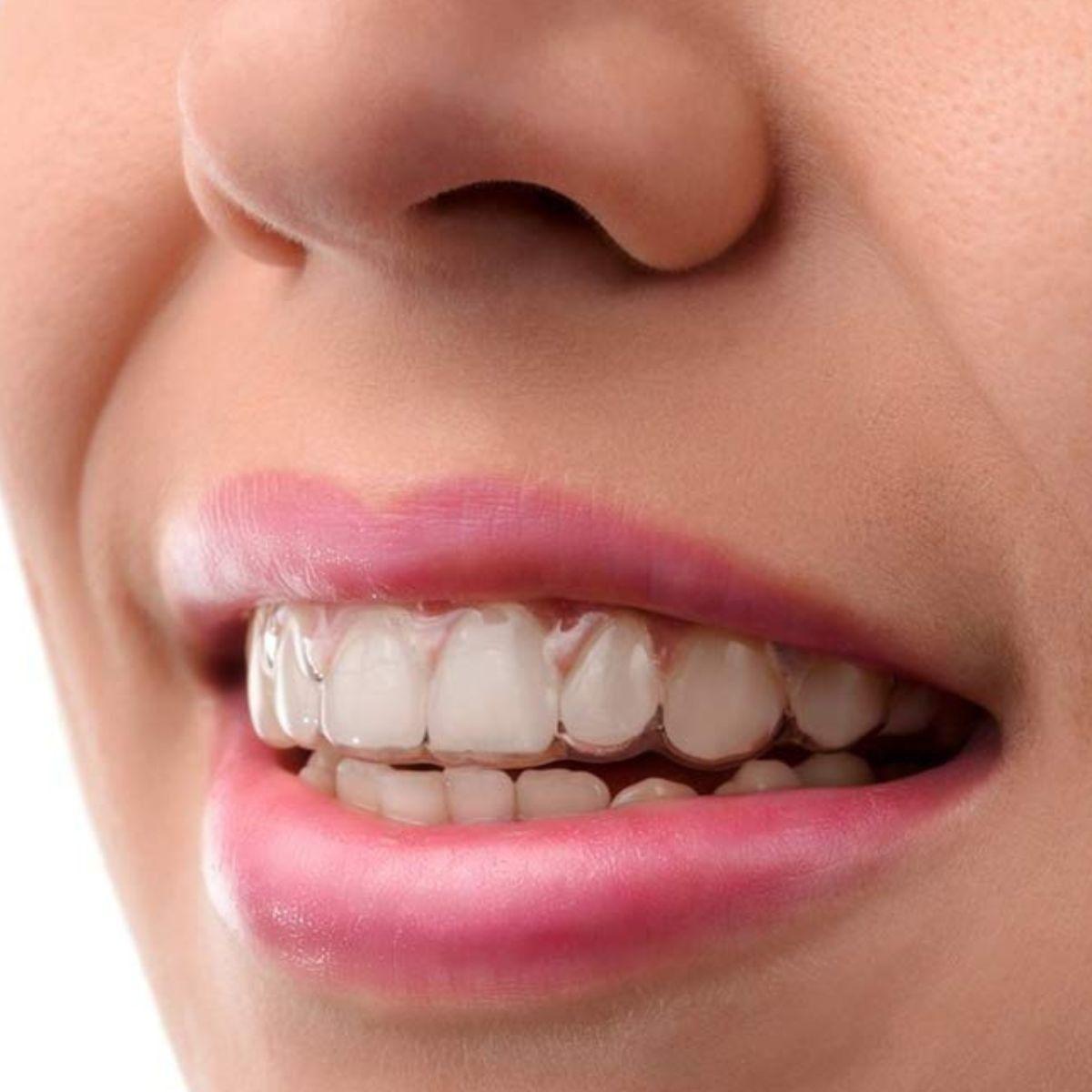 SET 3 PROTECTOR PLACA ANTI-BRUXISMO PROTECCION BUCAL LAU-3