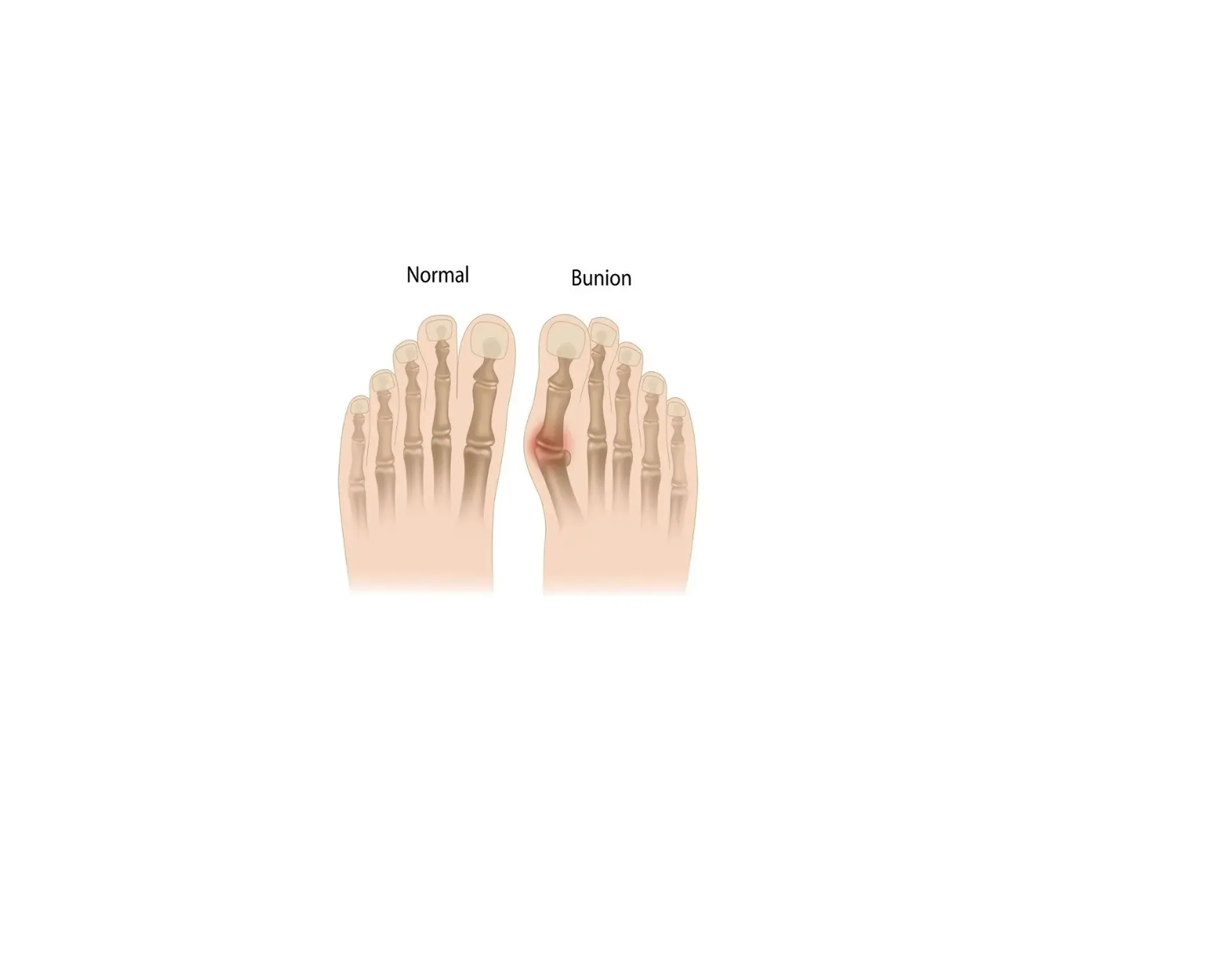 Par Corrector De Juanetes Hallus Valgus-1