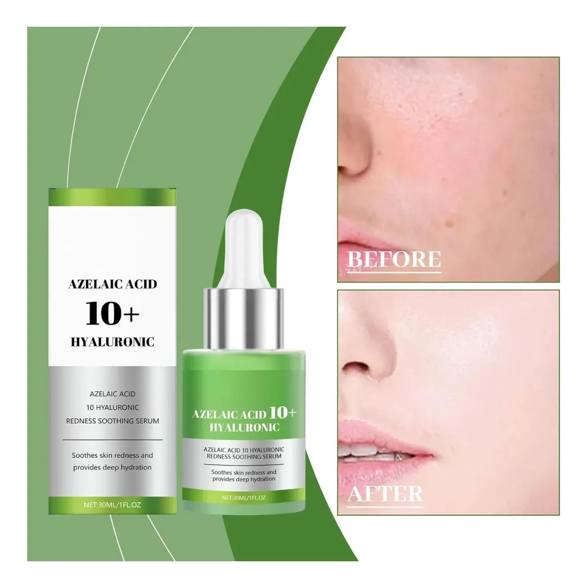 Serum Facial Antiacne Acido Azelaico 10% + Hialuronico Hoygi 30ml-4
