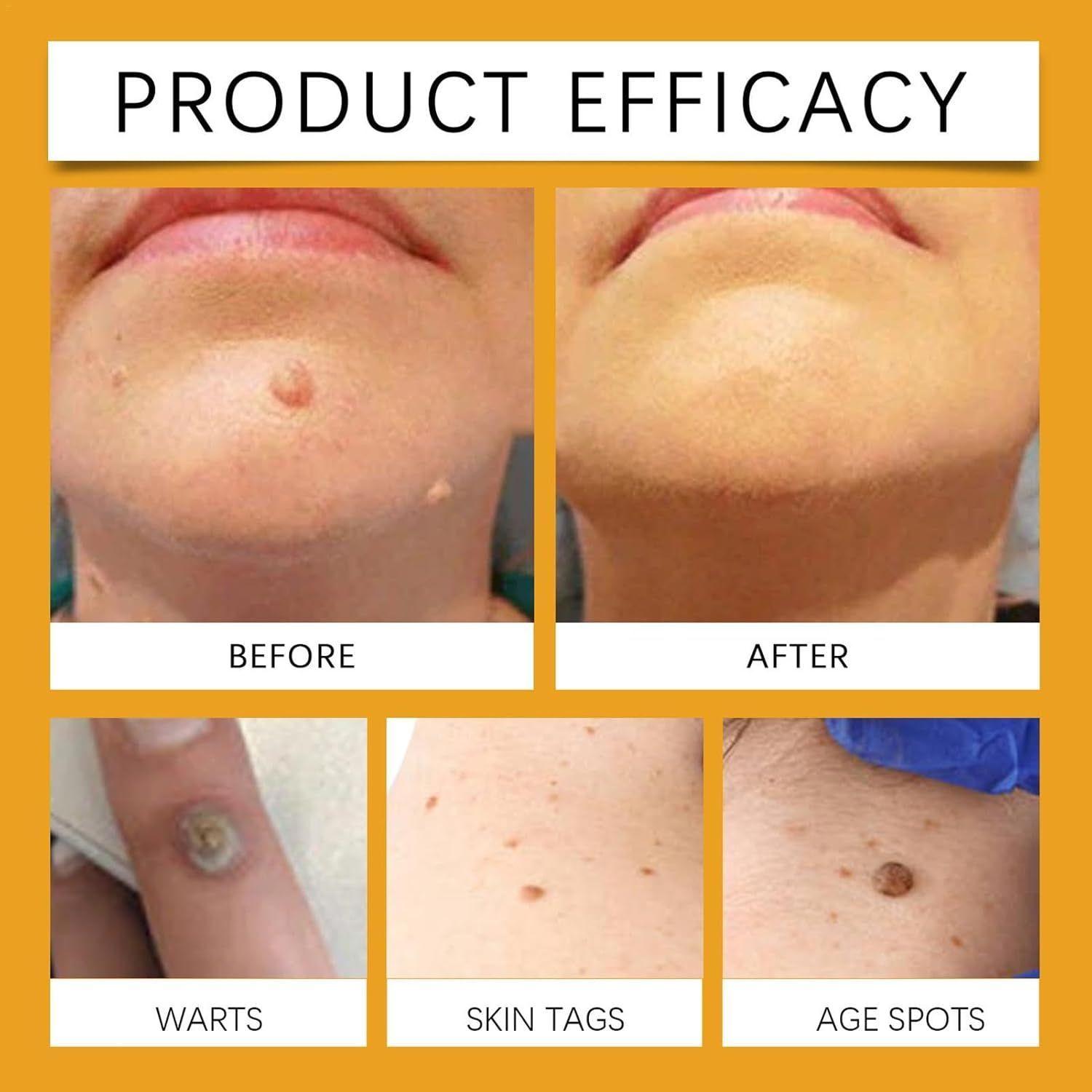 Botox Bee Venom Moles and Warts Crema de Cuerpo y Rostro para Remover Lunares y Verrugas 30gr-3