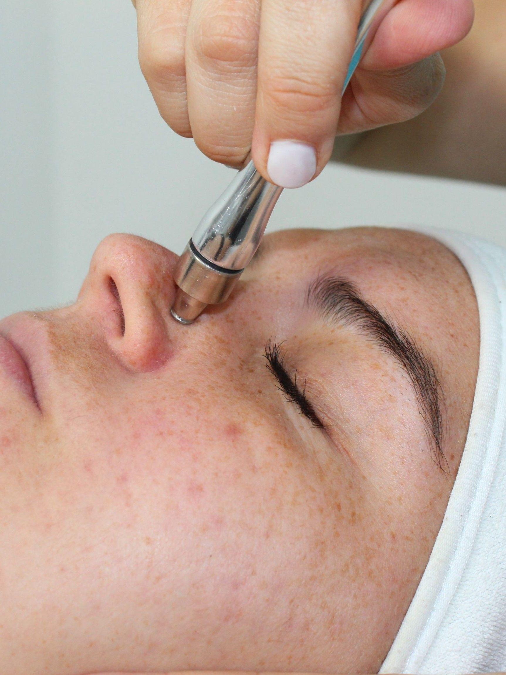 4 Sesiones de Peeling-1