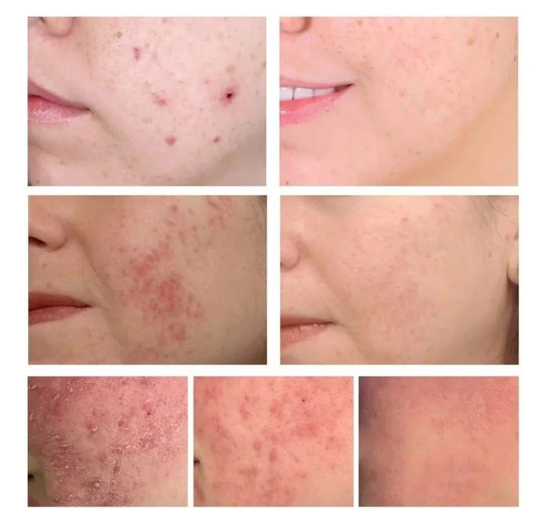 Serum Esencia Anti-Acné con Ácido Salicílico 40ml-4