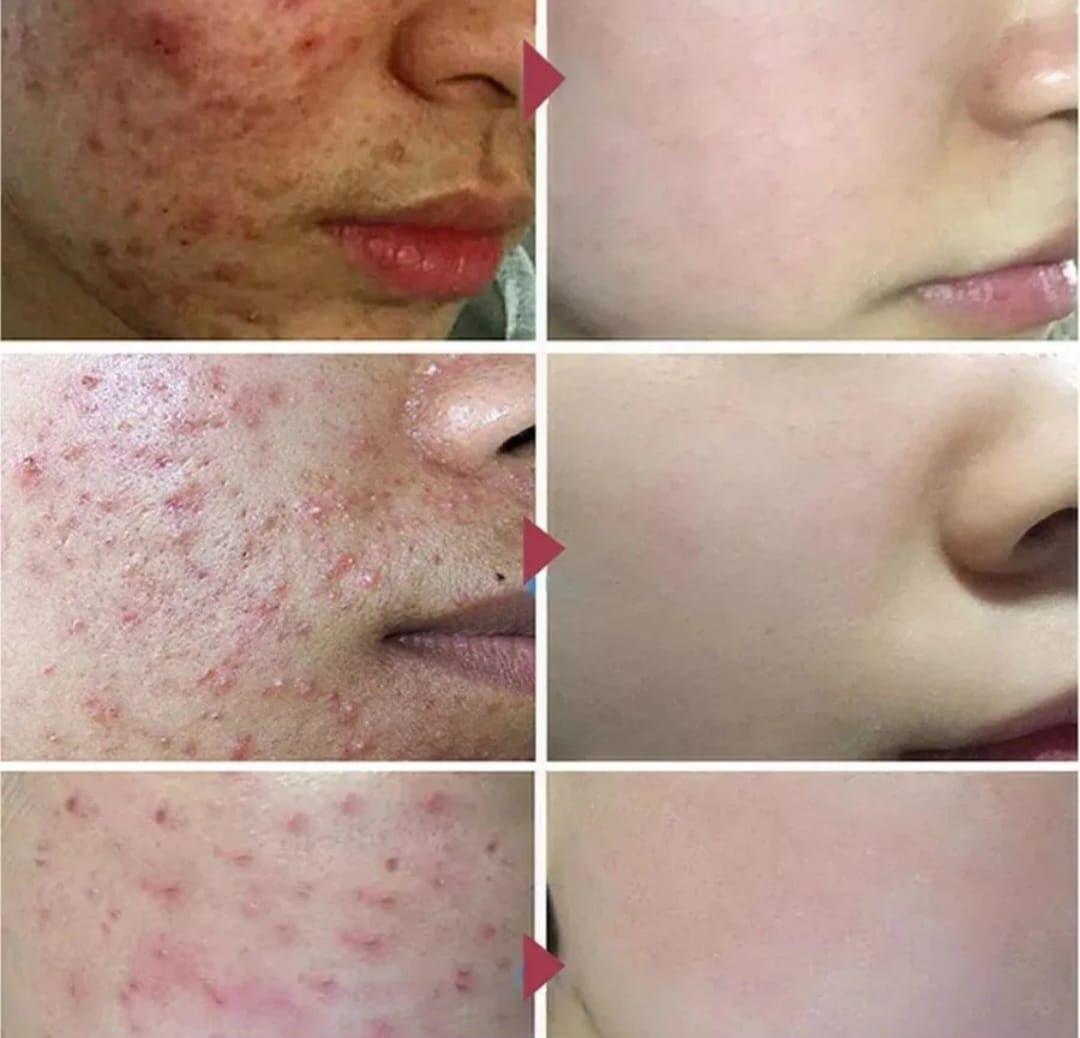 Serum Esencia Anti-Acné con Ácido Salicílico 40ml-5
