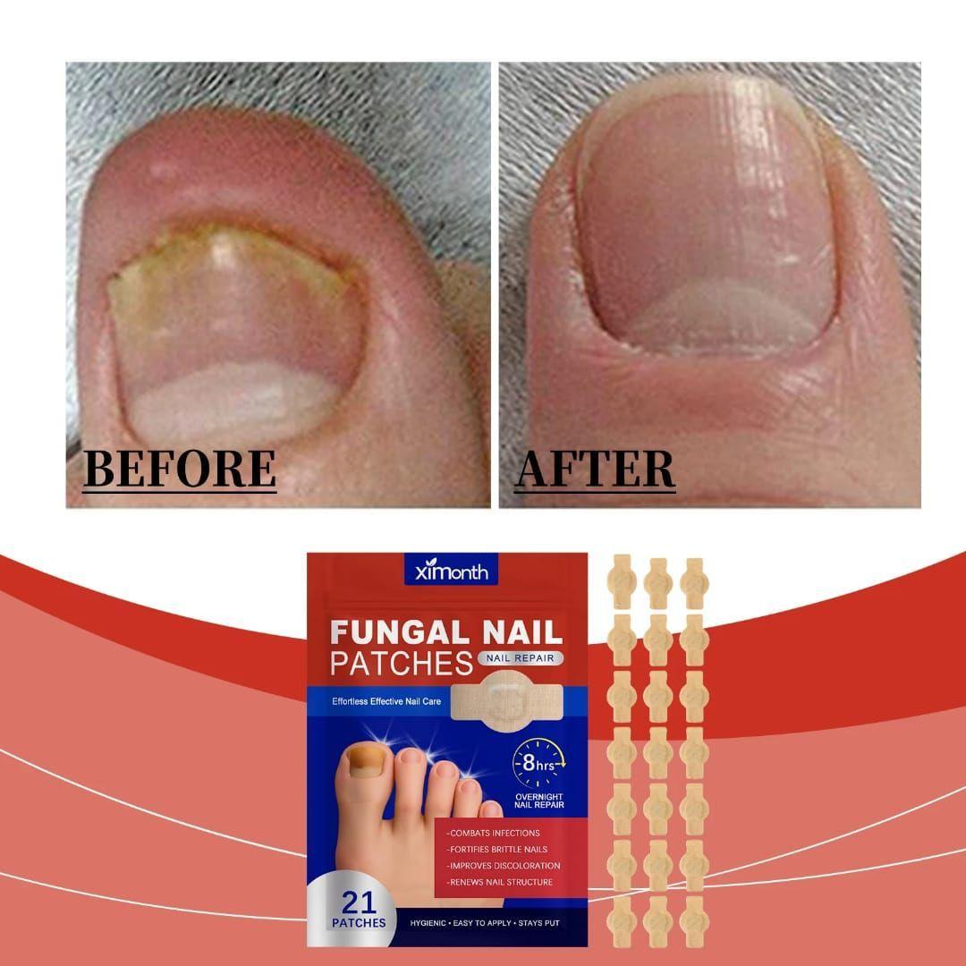 Parches Antihongos Parches Para Hongos Cuidado de U as 16 Unidades-5