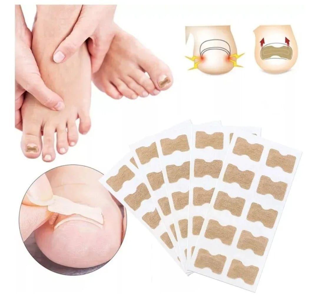 Kit de Corrección de Uñas Encarnadas-5