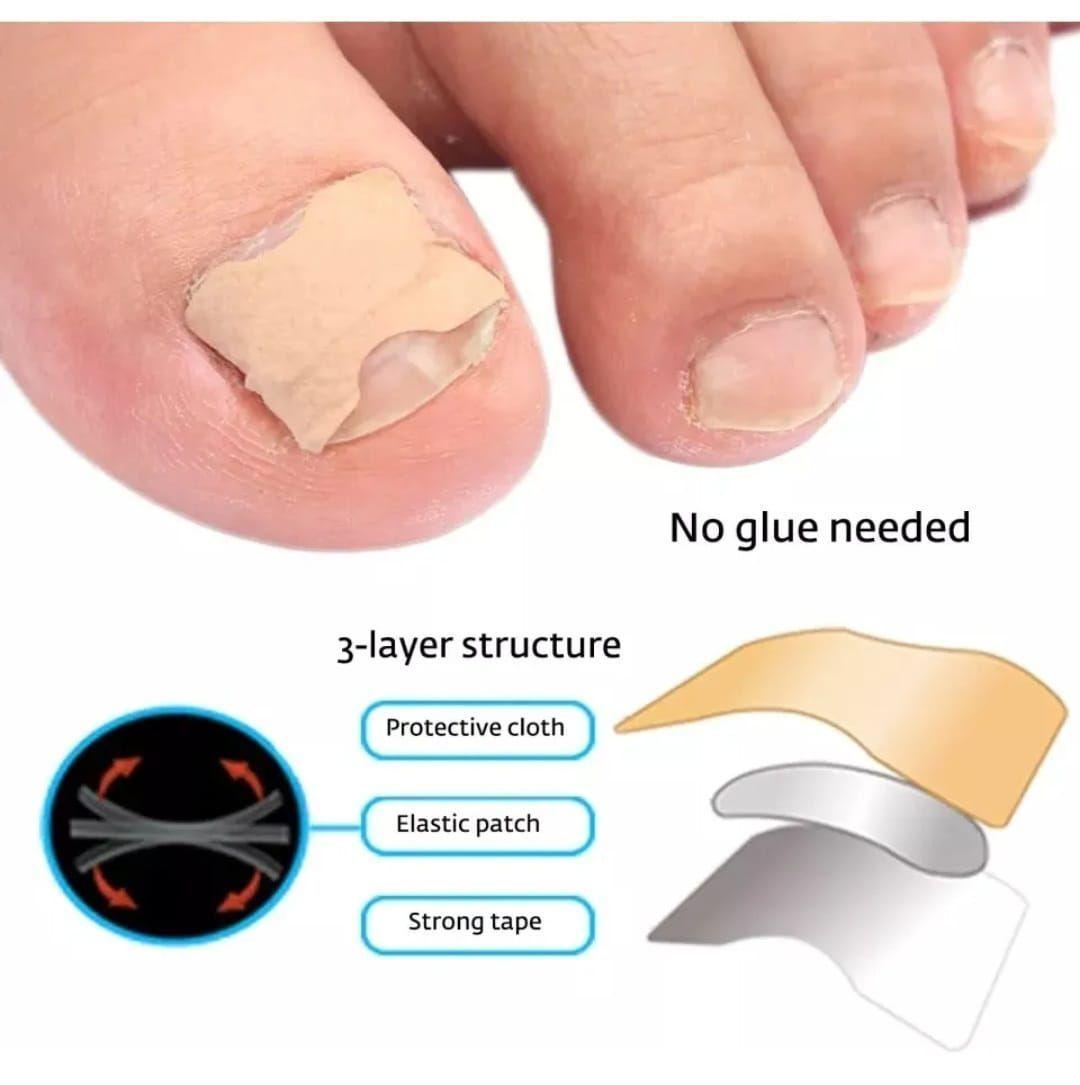 Kit de Corrección de Uñas Encarnadas-3