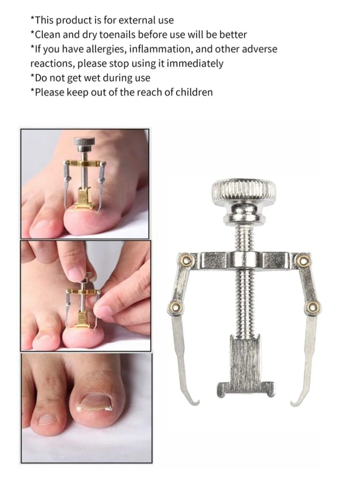 Kit de Corrección de Uñas Encarnadas-4