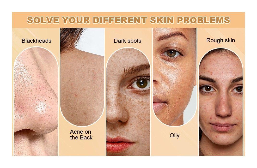 Jabon Kojic Acid En Barra Acido Kojico Blanqueador Anti Acne-4