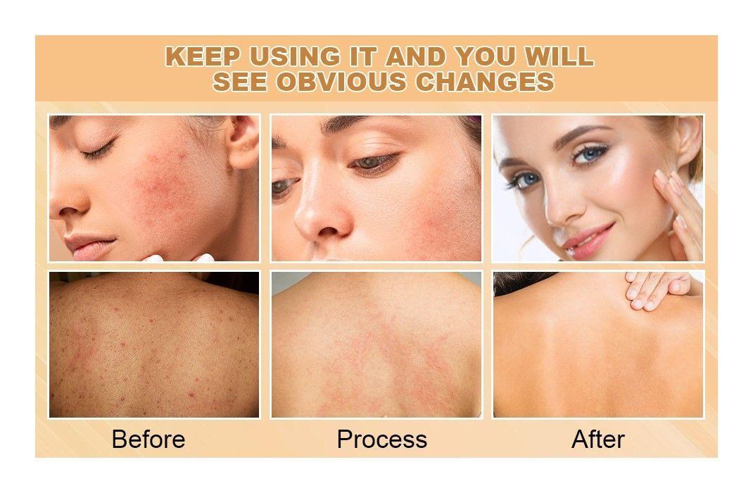 Jabon Kojic Acid En Barra Acido Kojico Blanqueador Anti Acne-5