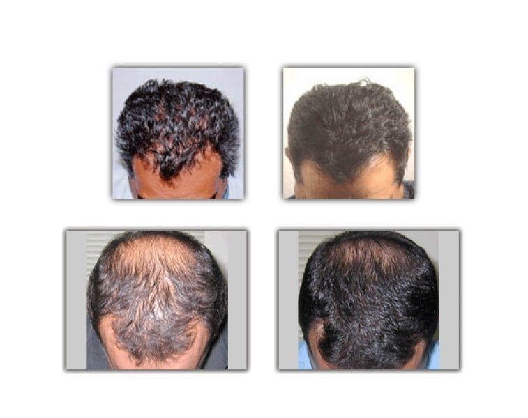 Cepillo Laser Fast Grow Comb Anti Caida Crecimiento Cabello-5