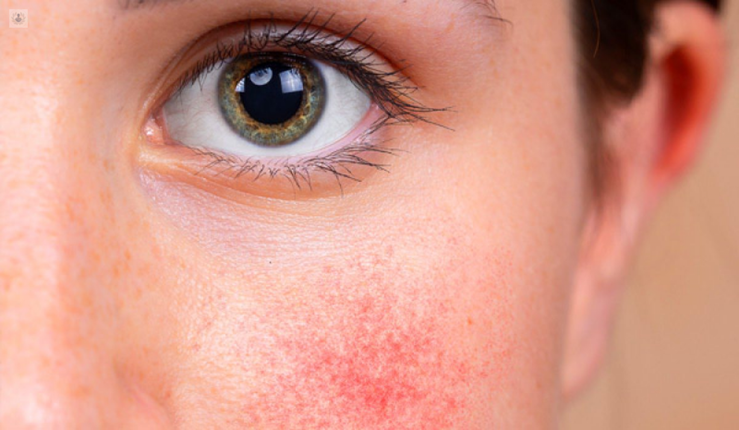 Rutina Completa PREANGE Anti Irritación y Rojeces-9