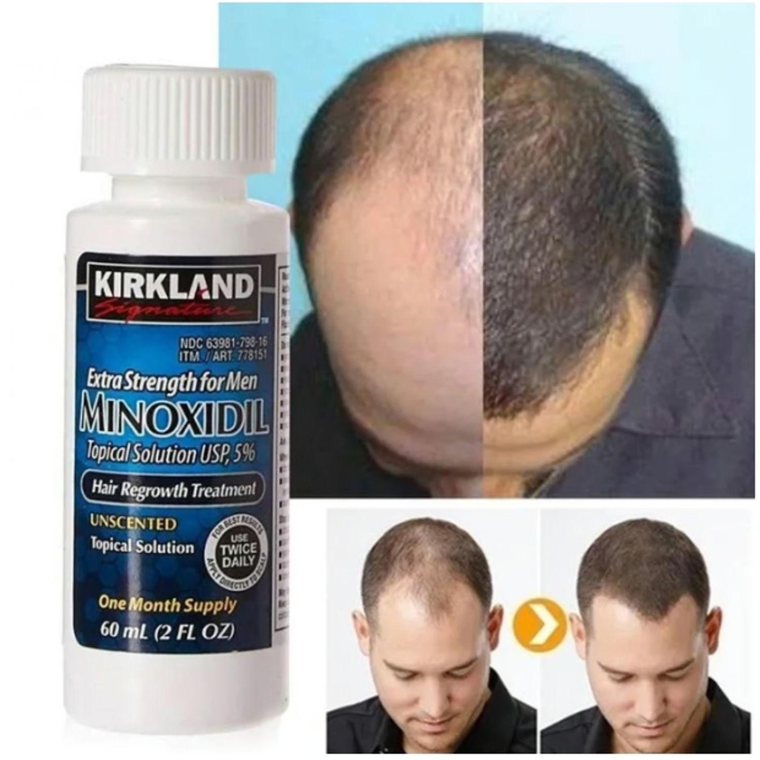 Minoxidil 5% Solución Tópica Tratamiento Regenerativo 6 Unds-1