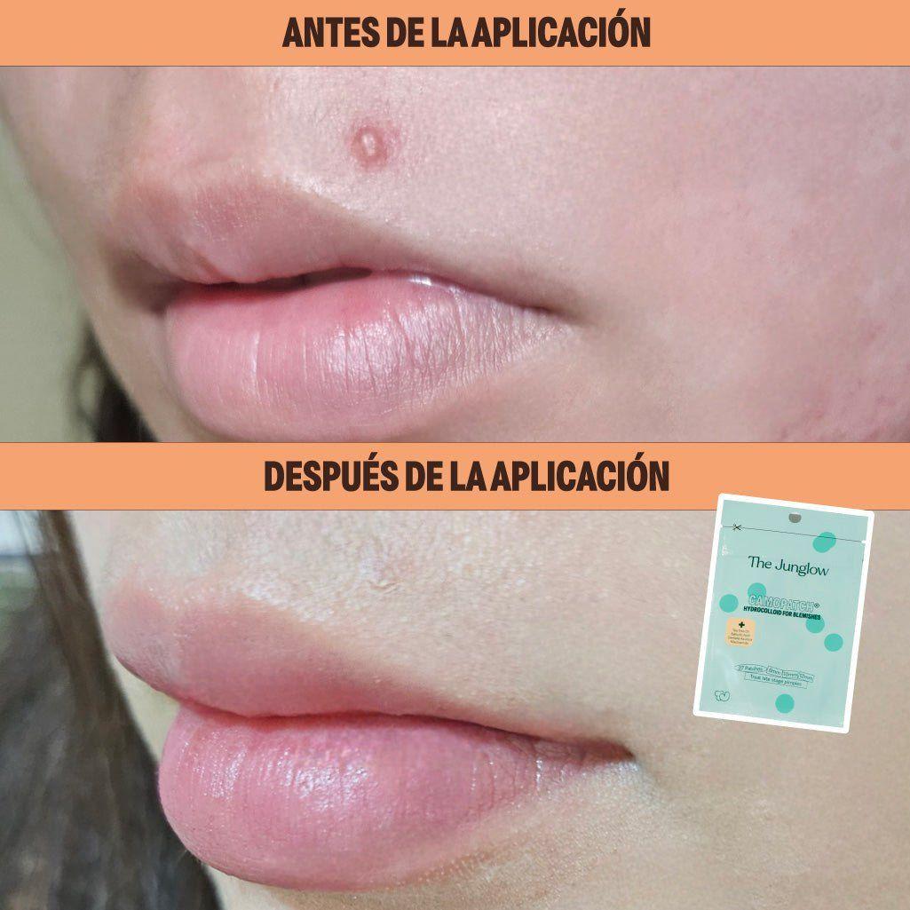 Parche Hidrocoloide Antiacné The Junglow-4