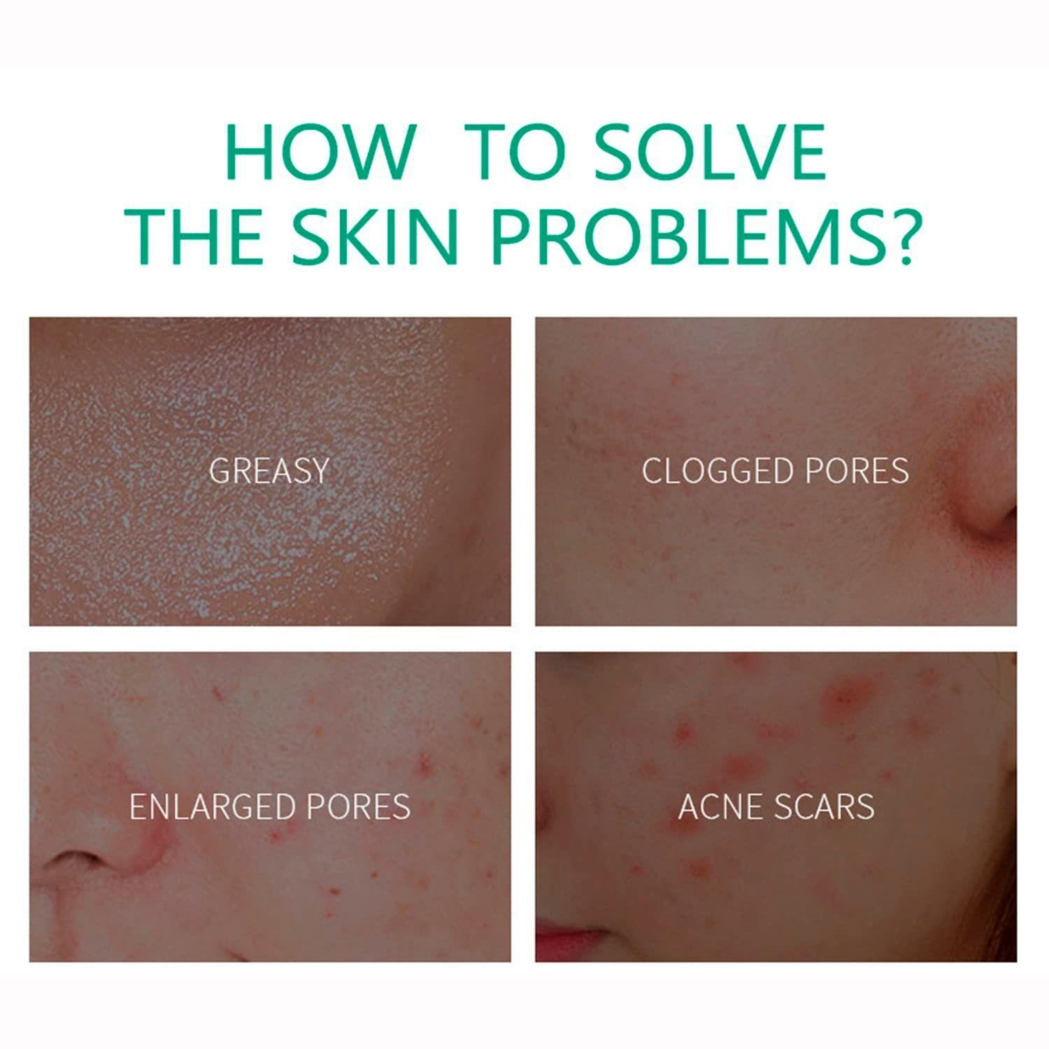Crema Facial Anti Acné Ácido Salicílico Eficaz -2