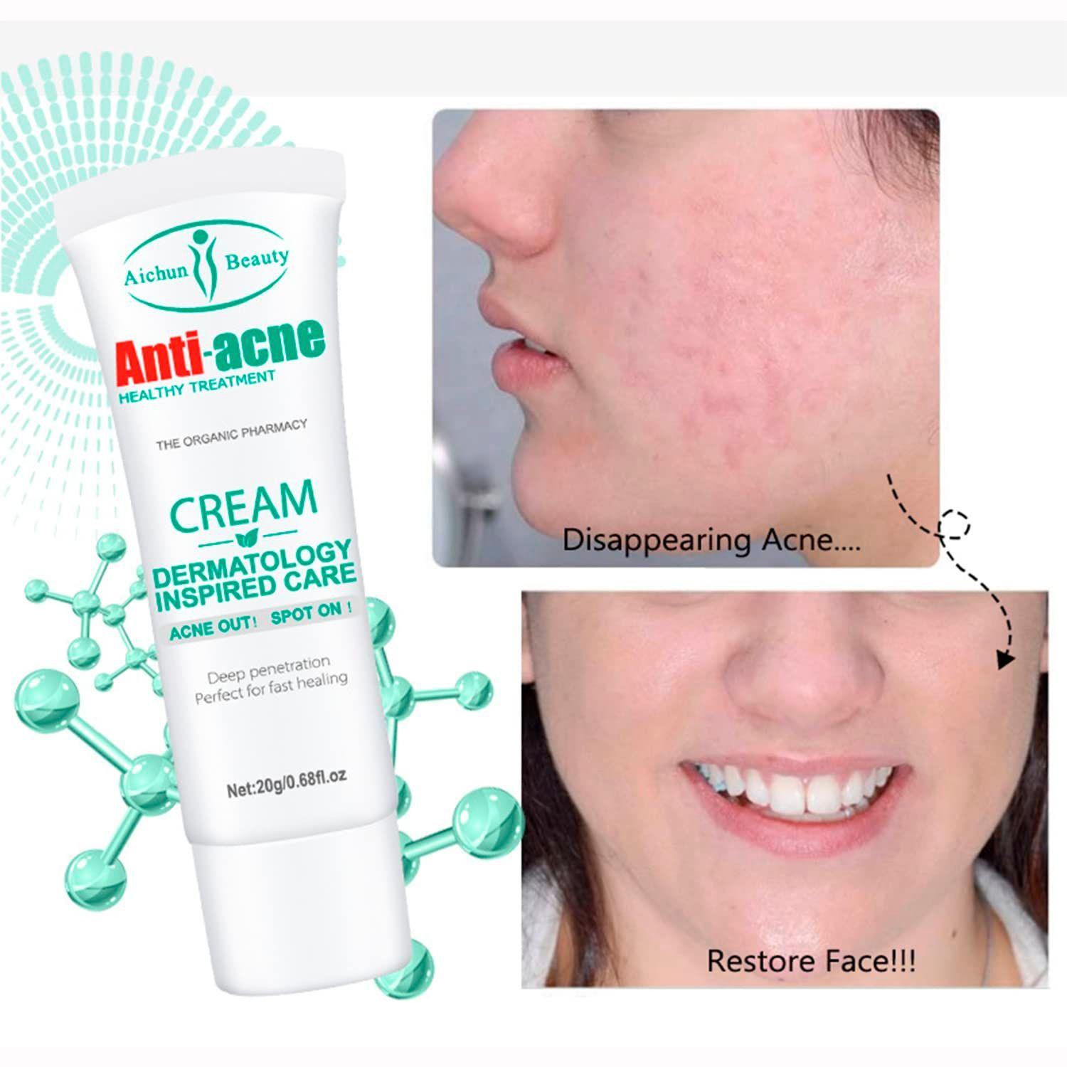 Crema Facial Anti Acné Ácido Salicílico Eficaz -4