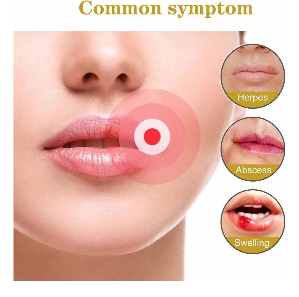 Parches Para El Herpes Labial Parches De Miel E Hidrocoloide-3