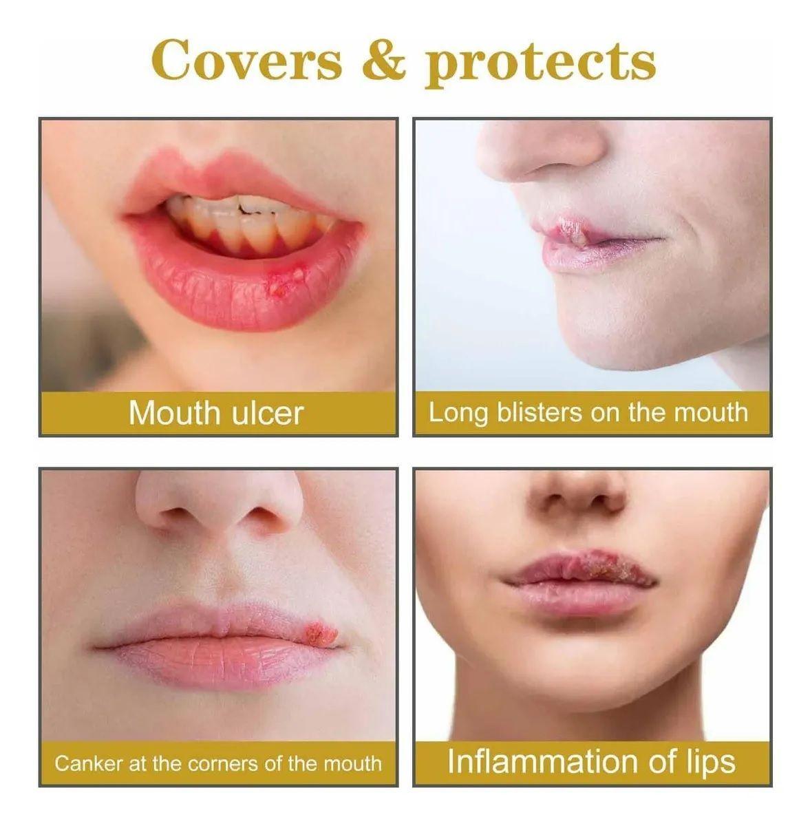 Parches Para El Herpes Labial Parches De Miel E Hidrocoloide-5