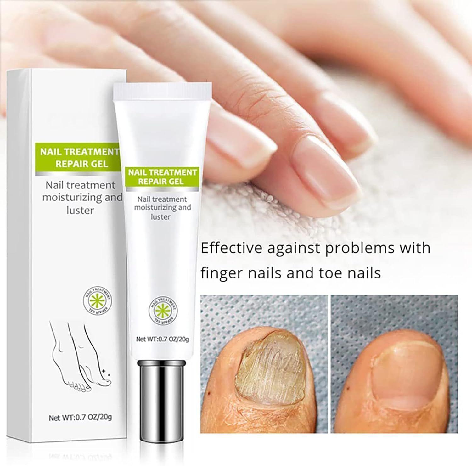 Crema de reparación de uñas antifúngica hongos (1 pieza, 20g)-2