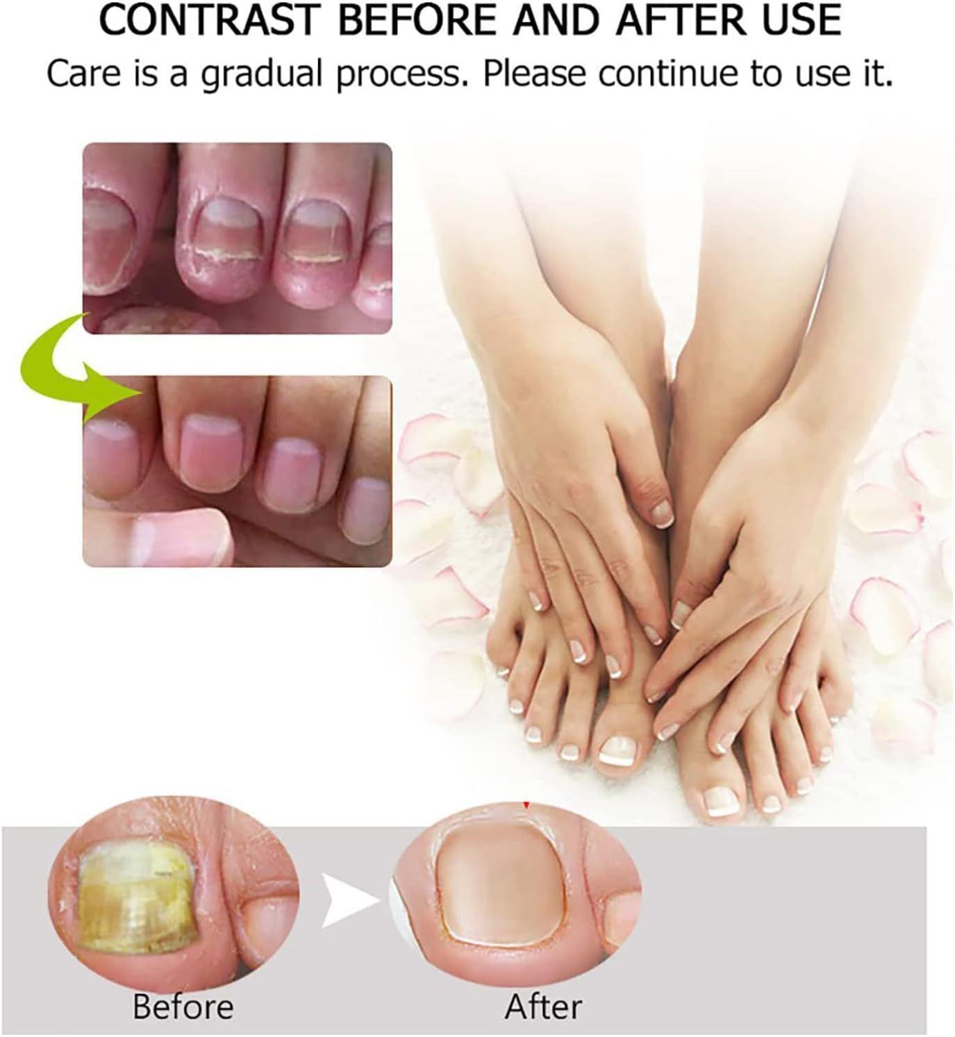 Crema de reparación de uñas antifúngica hongos (1 pieza, 20g)-3