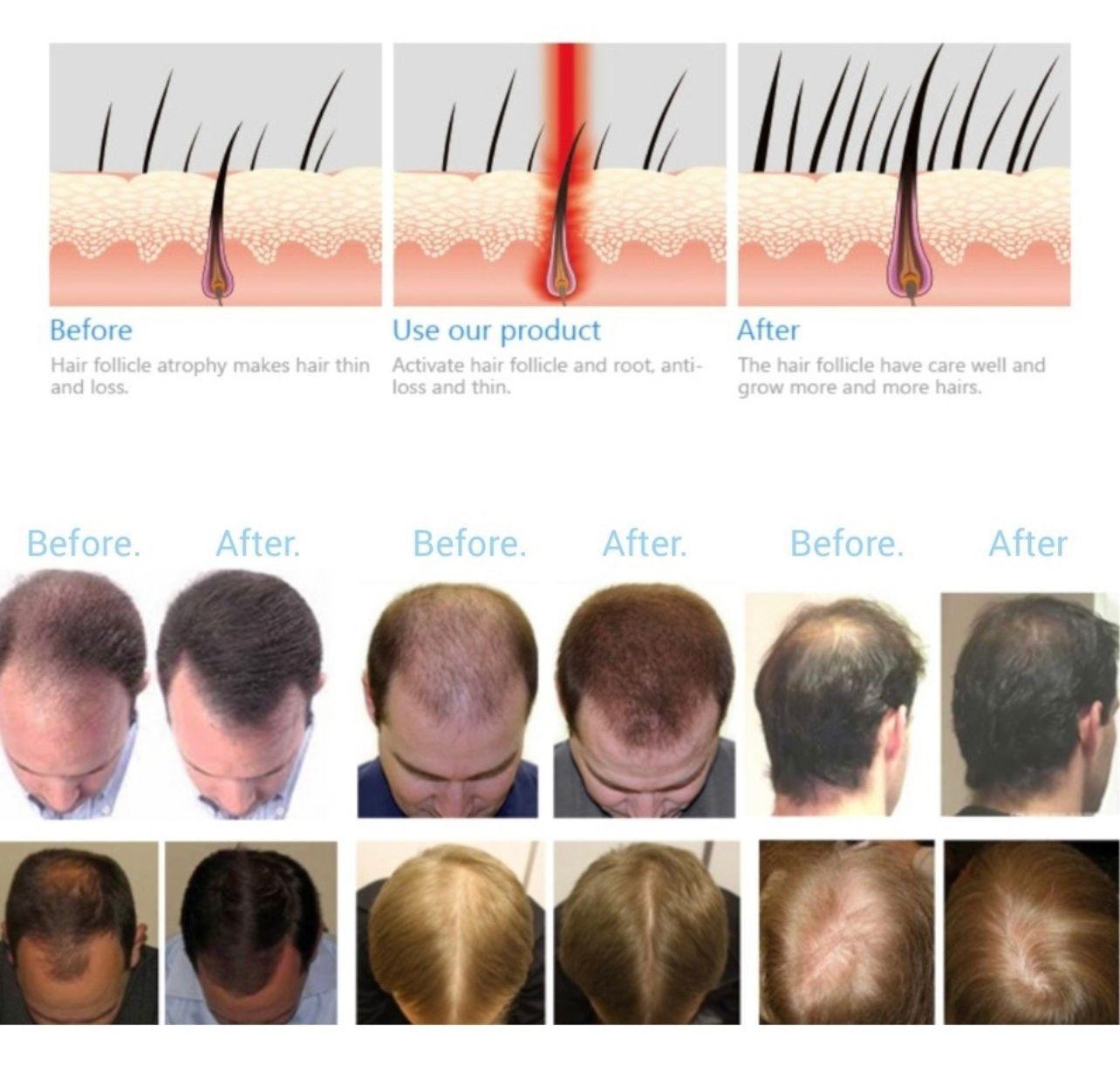 Casco de Terapia Láser Para el Crecimiento del Cabello-3