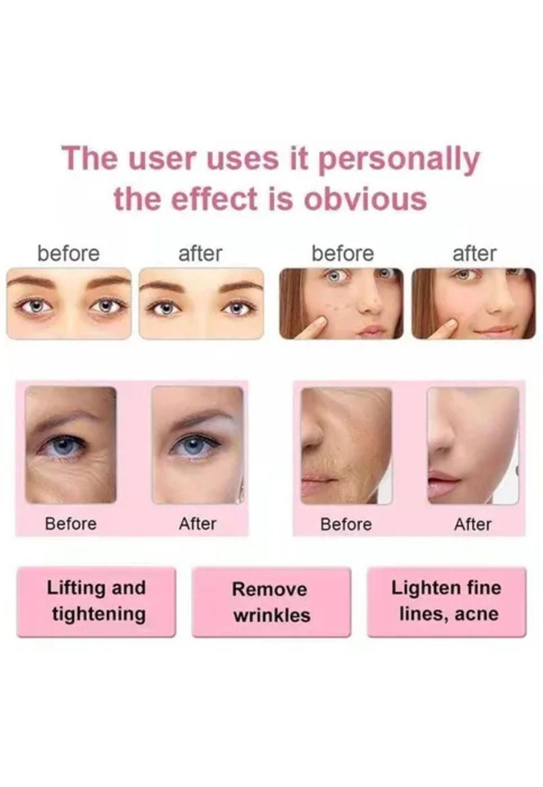 Masajeador Ultrasónico Cavitación 4 En 1 Limpieza Facial-6