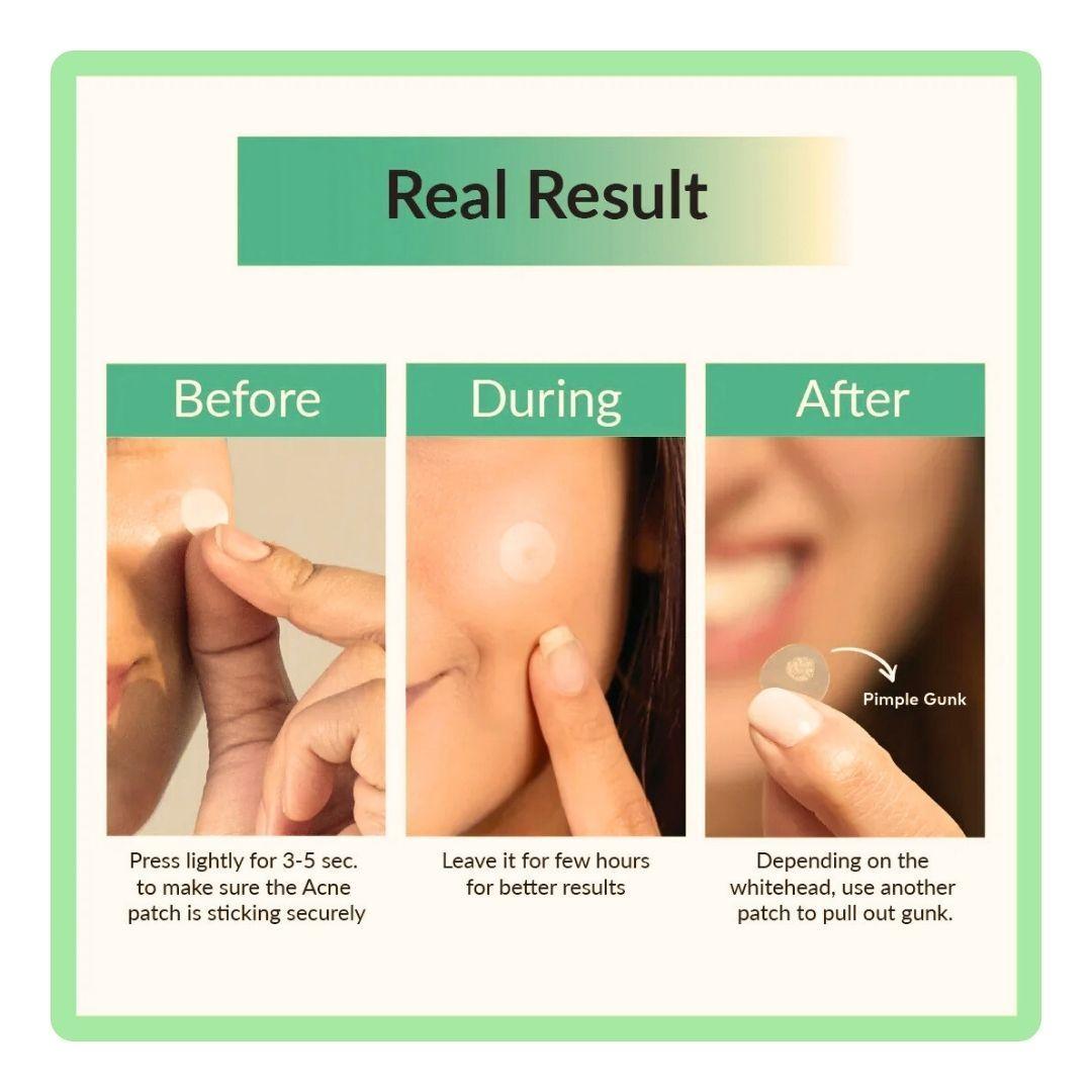 Parches Anti Imperfecciones Clear Spot Patch-2