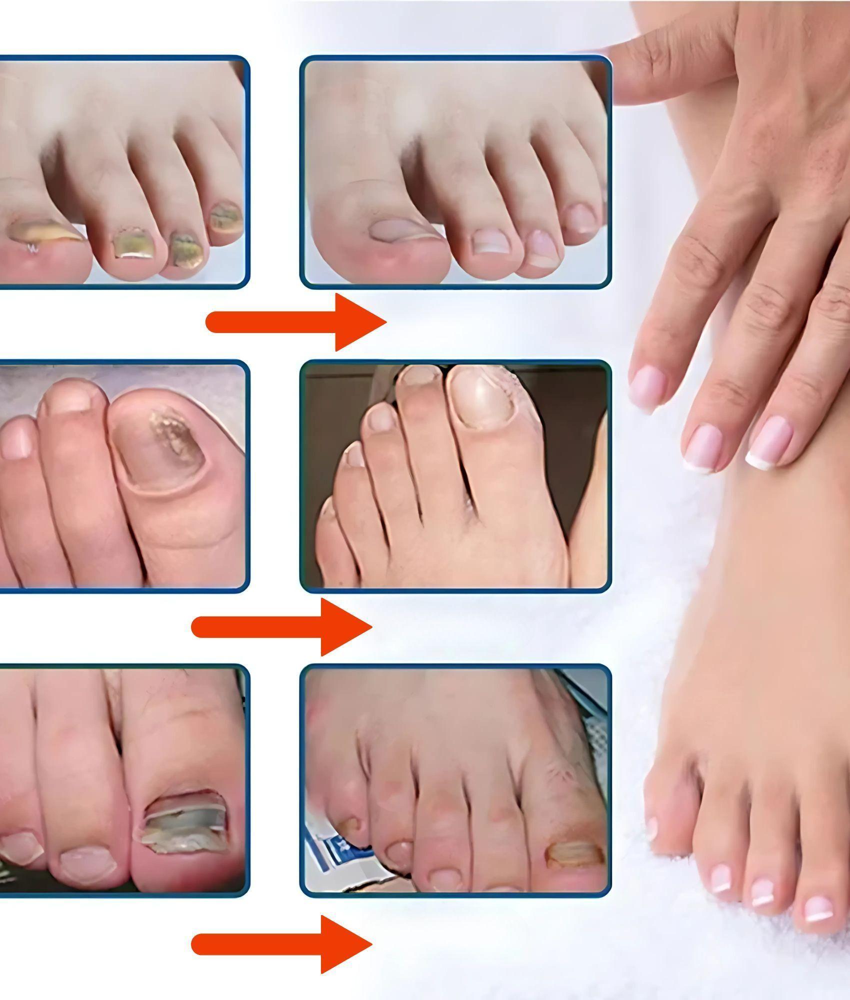 Parche Uñas Tratamiento Renovación Nocturna Pack 7 Jhn-5