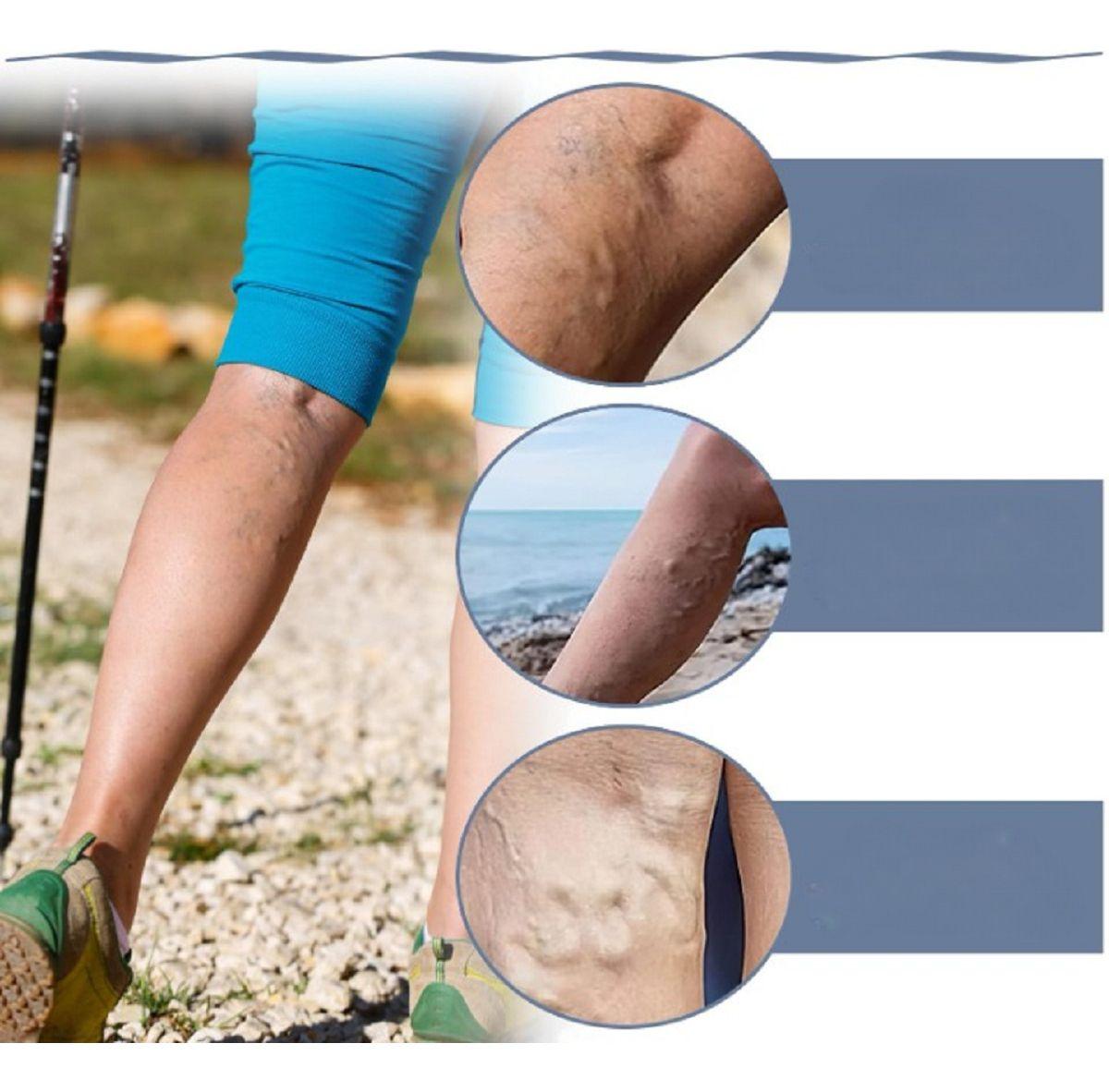 Set 10 Packs Varices Extractos Natural Pierna Cansadas Lau-7