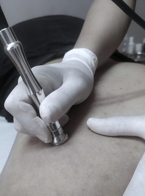 Limpieza Espalda Con Terapia Fotodinámica-1