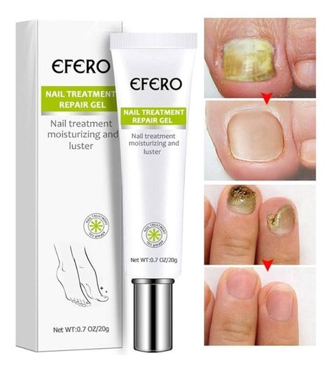 Elimina Hongos En Uñas Onicomicosis Nueva Formula-2