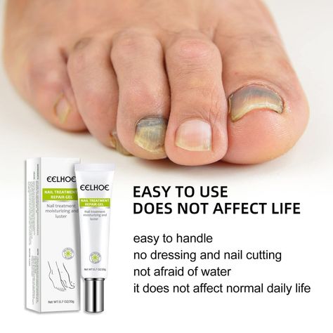 Elimina Hongos En Uñas Onicomicosis Nueva Formula-4