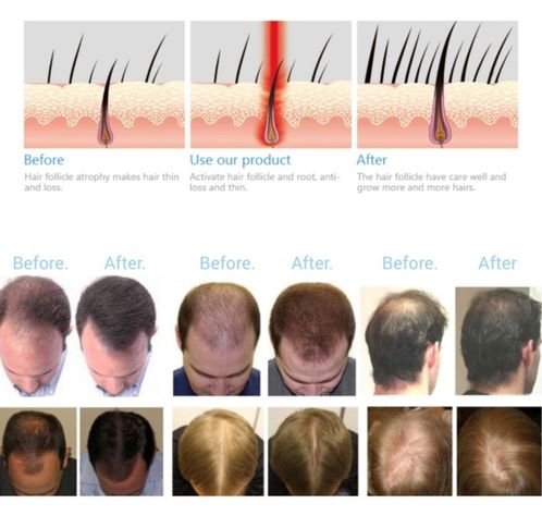 Casco de Terapia Láser Para el Crecimiento del Cabello-3