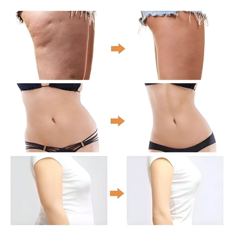Máquina Liposucción Masajeador Adelgazante Jhn-2