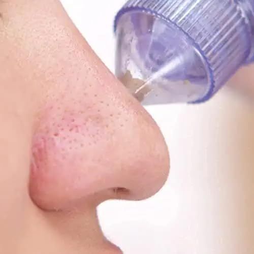 Limpiador Facial Succionador Puntos Negros Acné Rondon-2