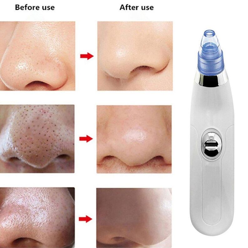 Limpiador Facial Succionador Puntos Negros Acné Rondon-5
