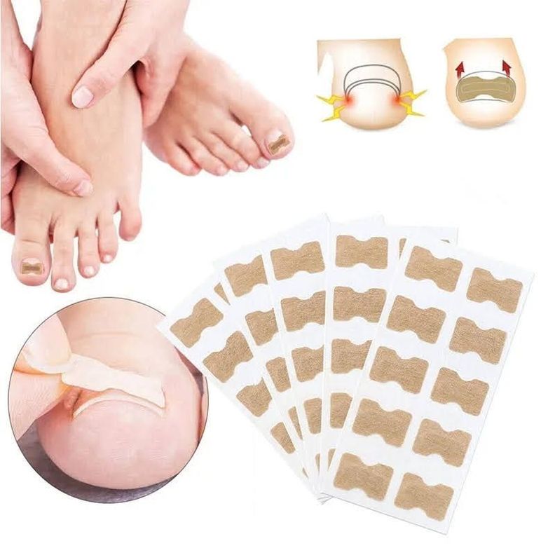 Pack x30 Parches Para Corregir Uña Encarnada Corrector Pie-5