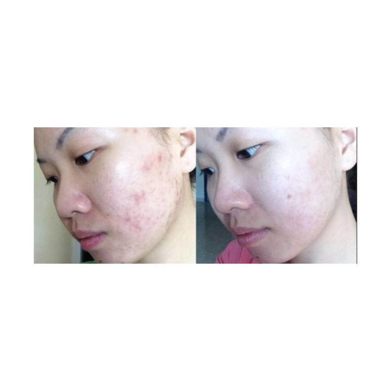 Crema antiacné - Acnix Cream-1